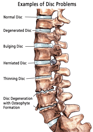 intervertebral disc degeneration examples