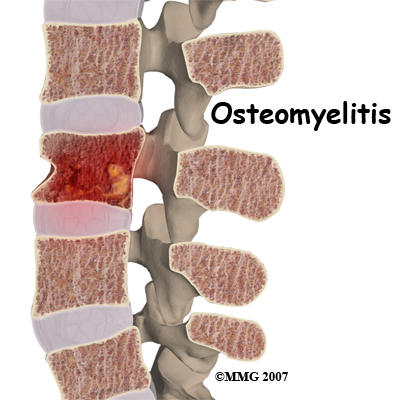 osteomyelitis